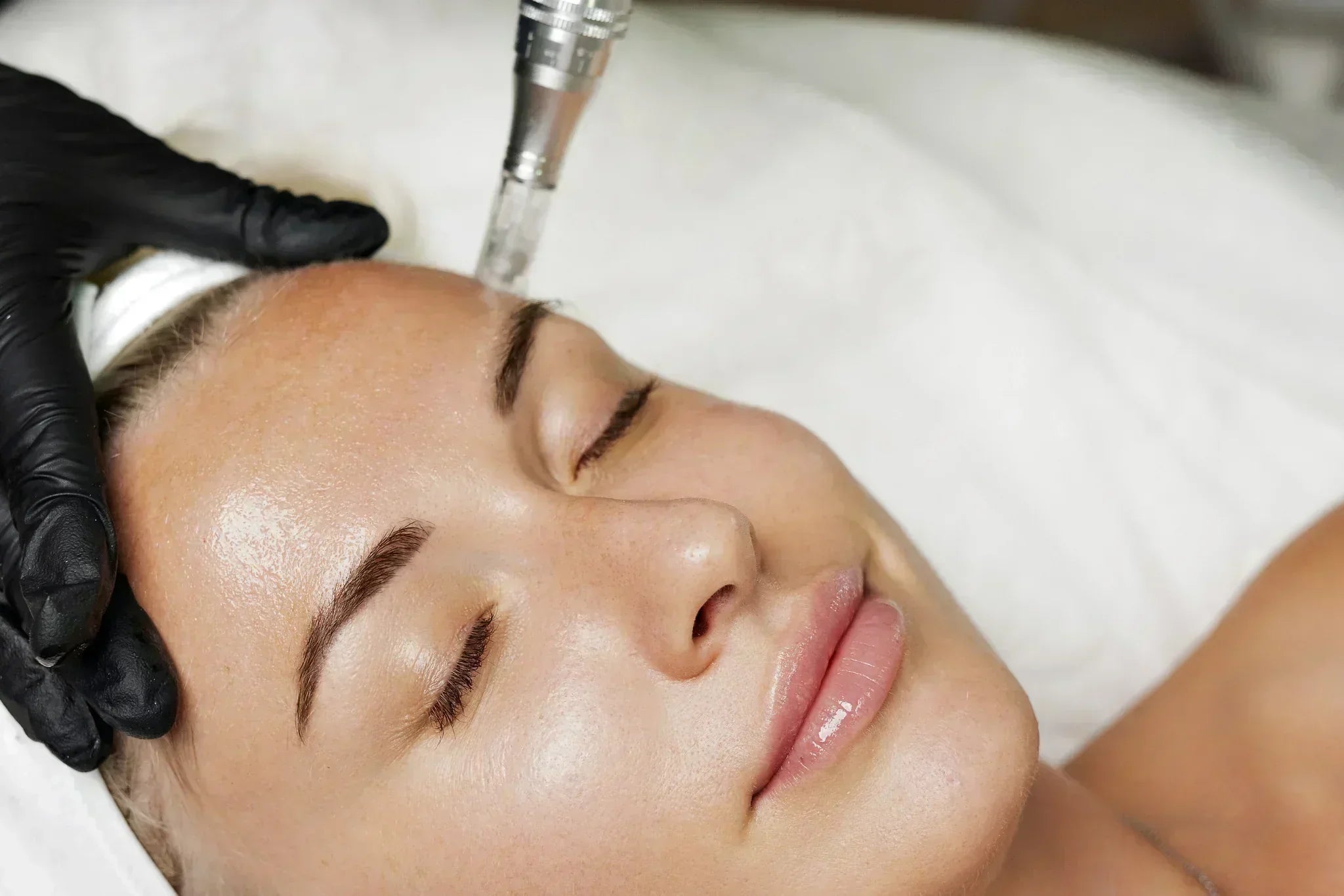 Close-up of a woman receiving a microneedling treatment on her forehead while lying down with her eyes closed.