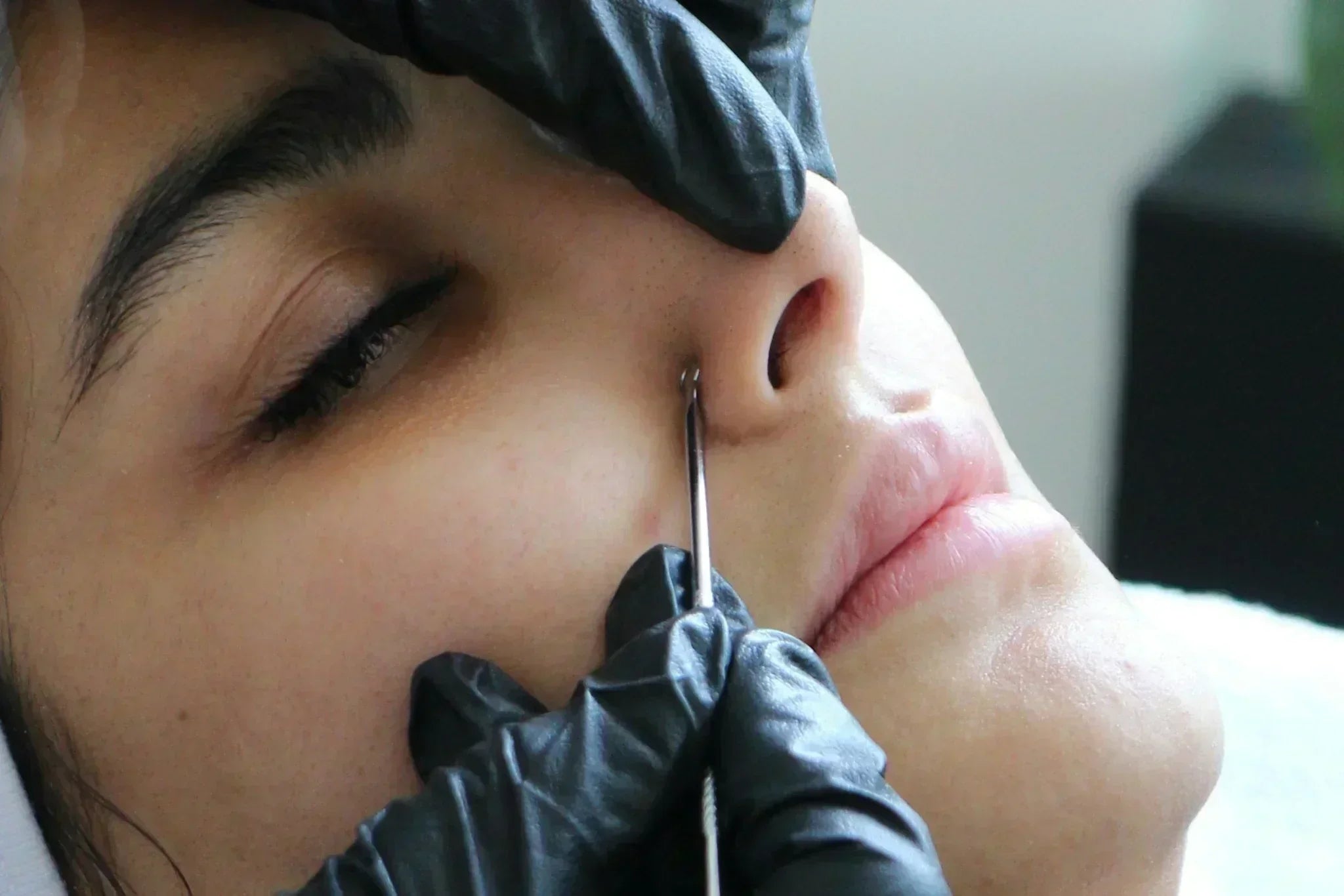 woman having a skin extraction done close-up