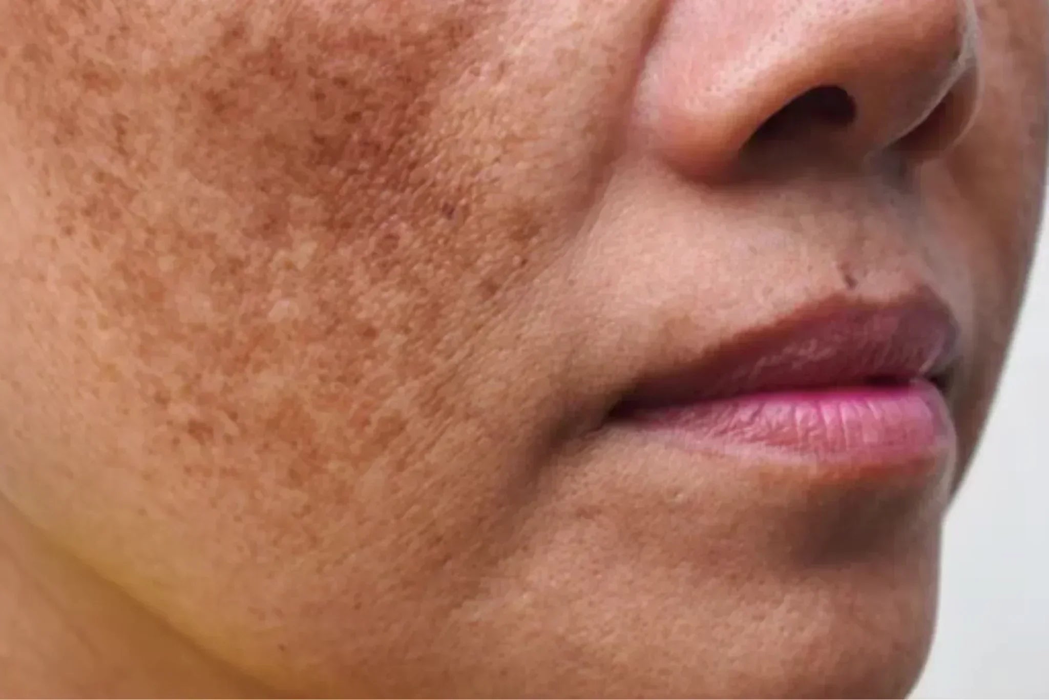 UNDERSTANDING AND MANAGING MELASMA