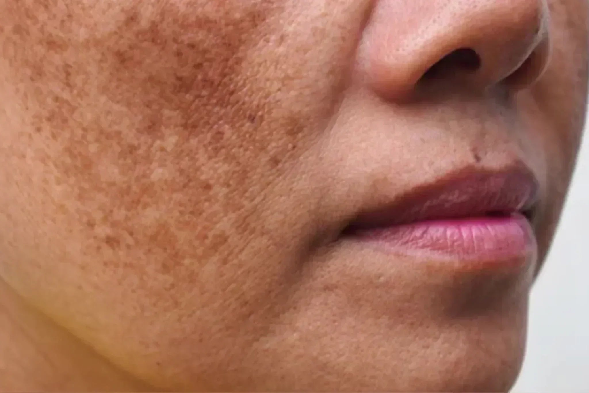 Close-up of a woman's cheek showing visible melasma and hyperpigmentation patches.
