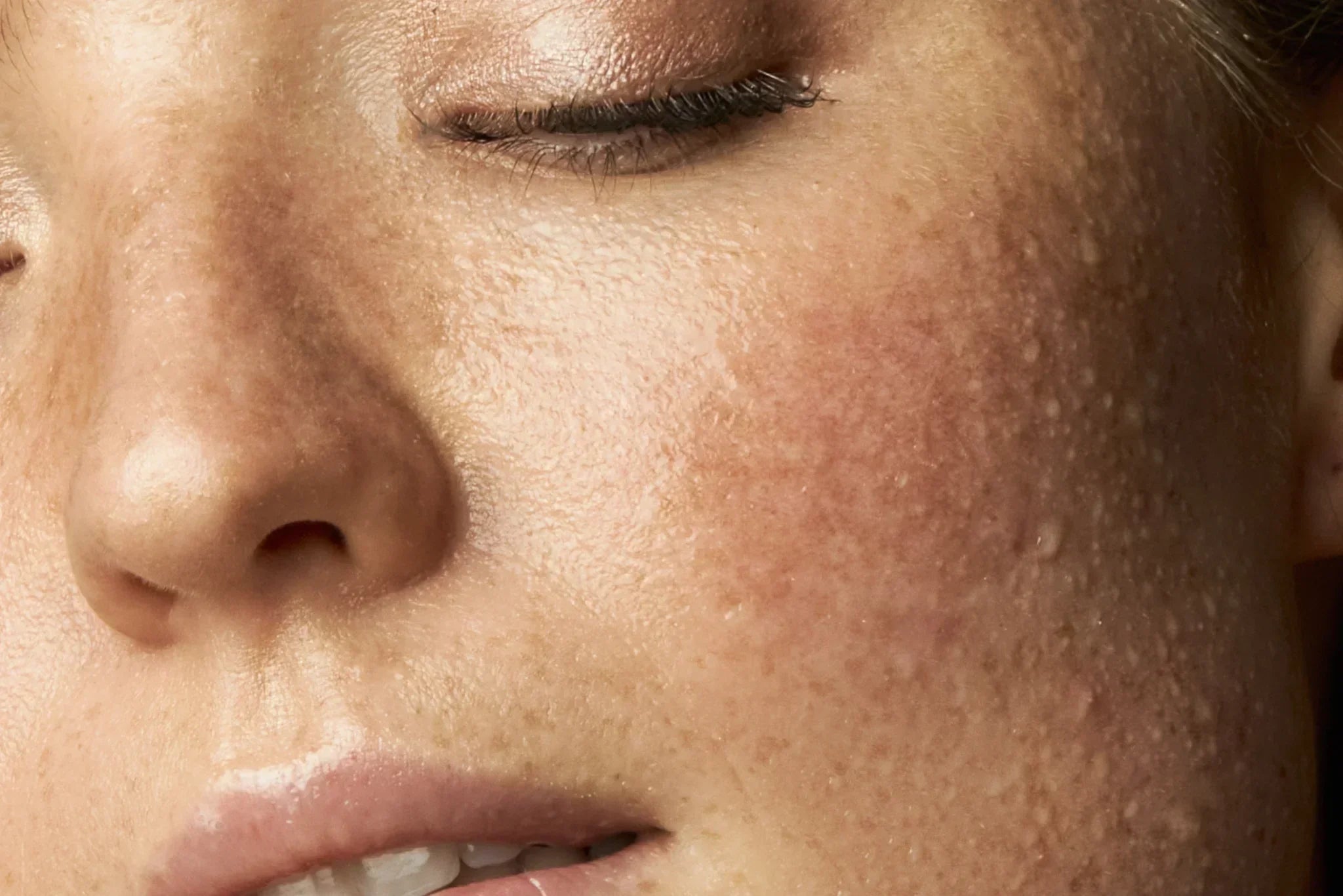 Close-up of dehydrated facial skin showing rough texture and moisture loss, illustrating common skin hydration myths.