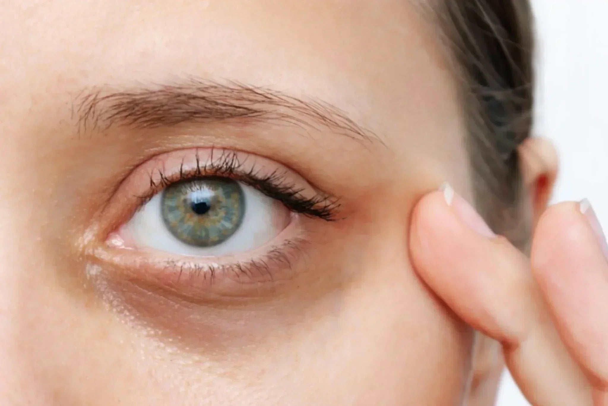 Close-up of under-eye skin showing dark circles, a common concern caused by dehydration, thinning skin, and pigmentation
