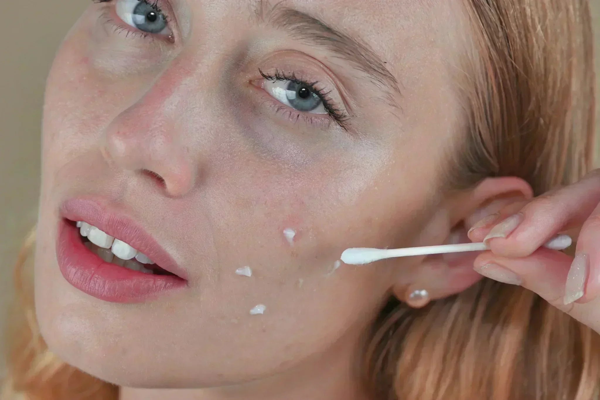 Close-up image of a woman applying acne spot treatment to blemish-prone skin with a cotton swab, illustrating targeted skincare application.