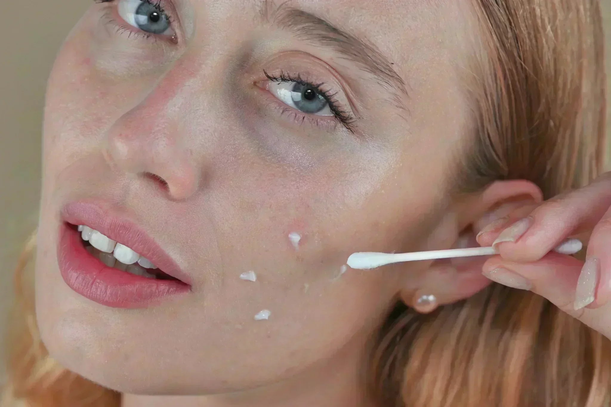 Close-up image of a woman applying acne spot treatment to blemish-prone skin with a cotton swab, illustrating targeted skincare application.