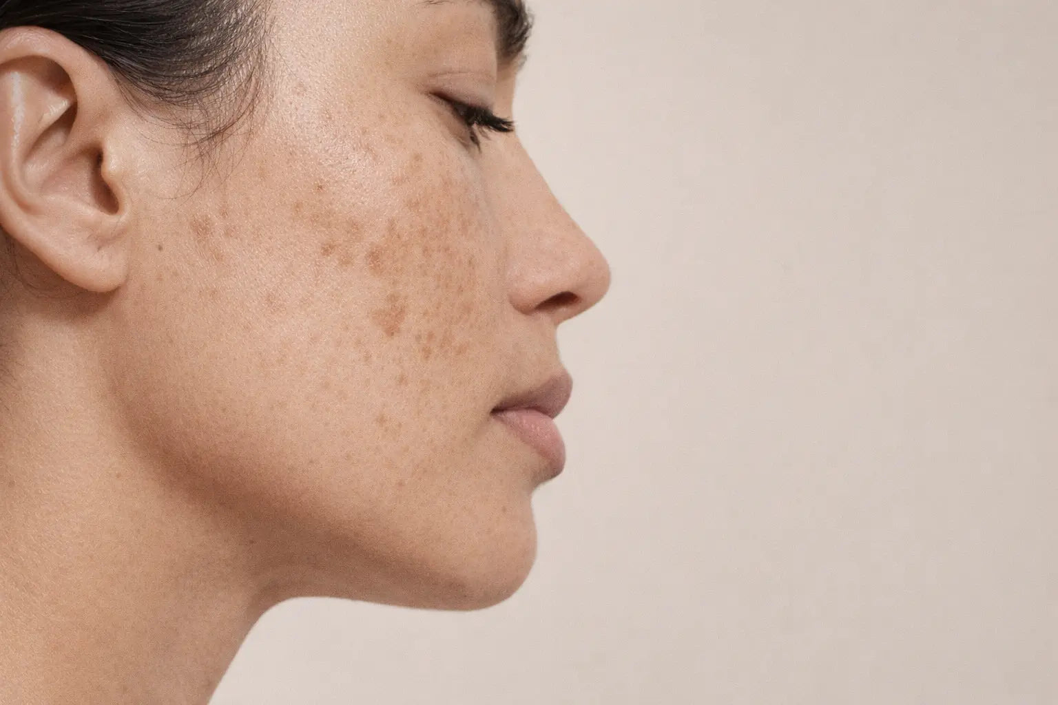 Close-up side profile of a woman with subtle hyperpigmentation and uneven skin tone on the cheek, shown against a soft neutral background. Natural skin texture and mild dark spots are visible in gentle studio lighting.