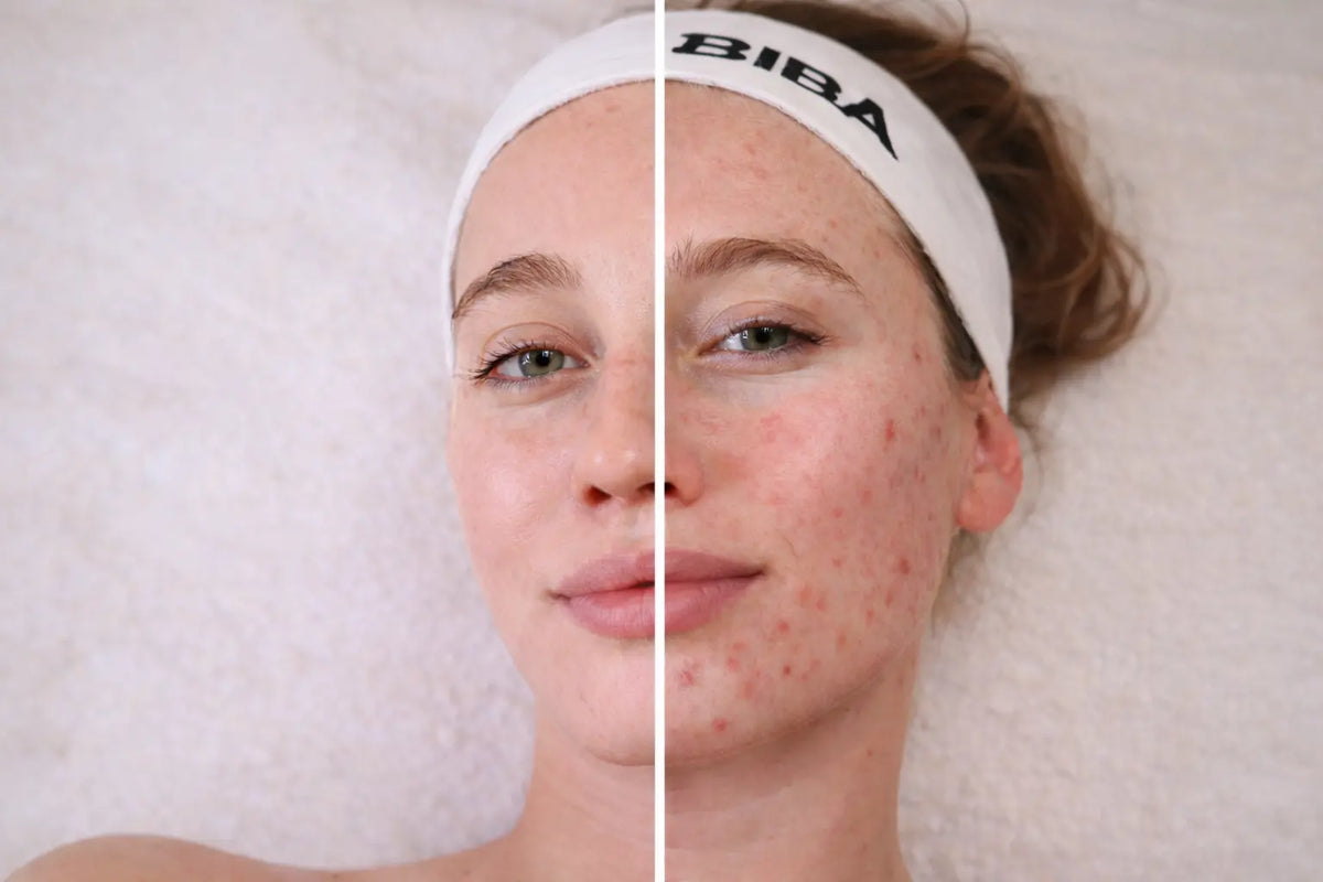 Split-face comparison of a woman’s skin showing clearer, smoother complexion on one side and inflamed acne and redness on the other.