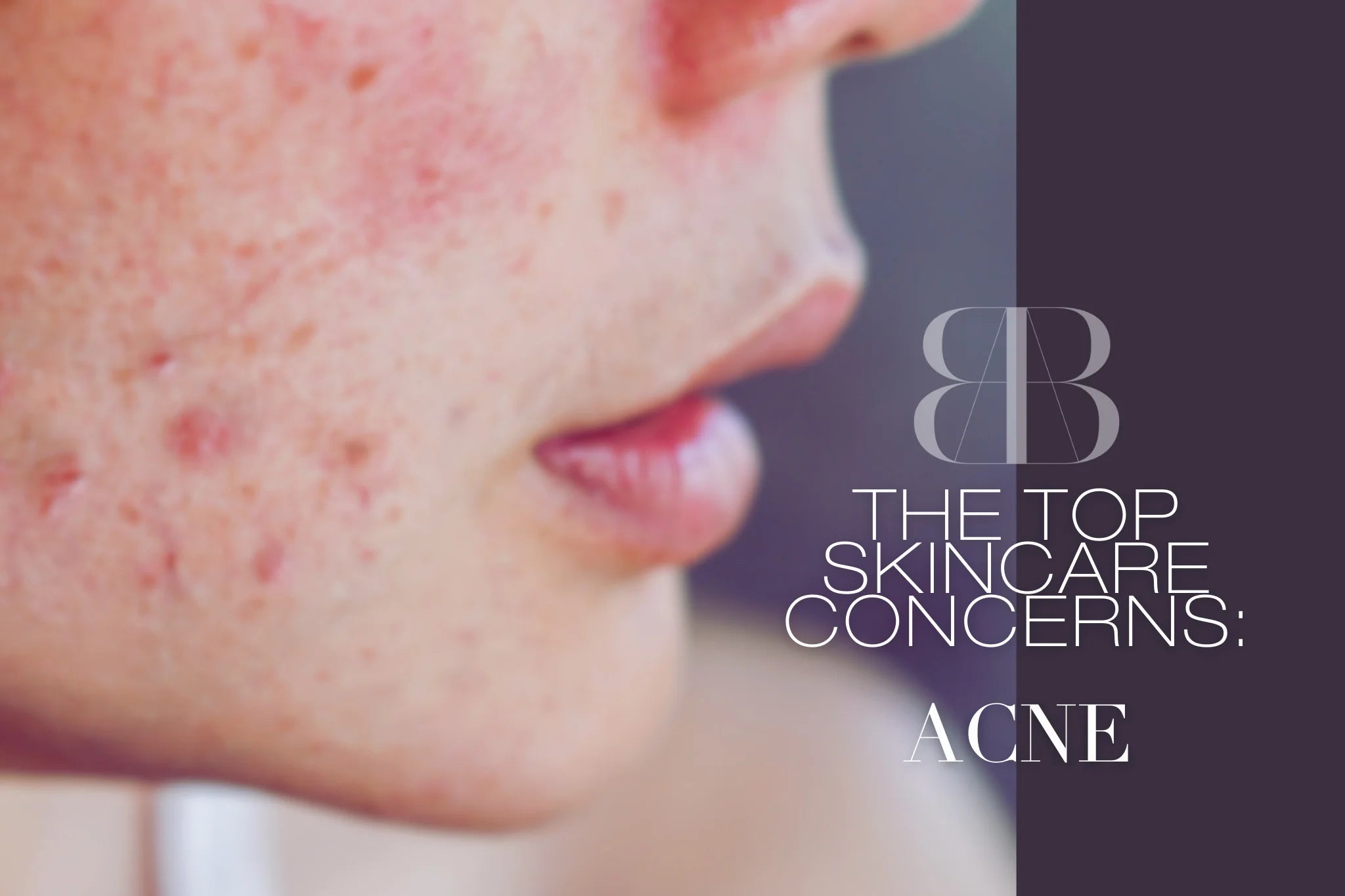 SKIN WITH BLEMISHES